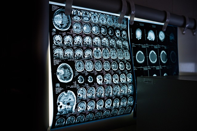 The 30 minutes that can change a stroke survivor's life